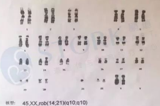 L女士的染色体报告，显示14号、21号染色体易位