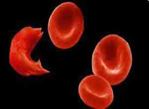 镰状细胞贫血