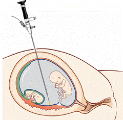 胎儿镜正在阻断双胎输血症