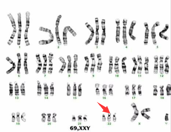 22号染色体三体